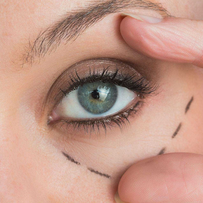 What happens if too much skin is removed after blepharoplasty?