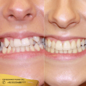 before after of teeth aligners in islamabad