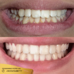 results of teeth aligners in islamabad