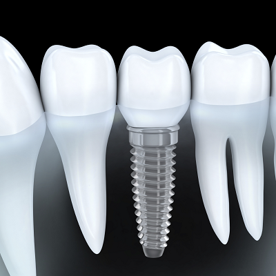 Best Clinic for Dental Implants & Crowns in Islamabad | RCS F-7