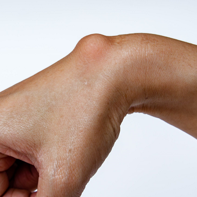 Best Clinic for Lipoma Removal Near me