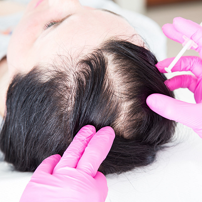 How Many Injections of Exosome Hair Therapy would I need