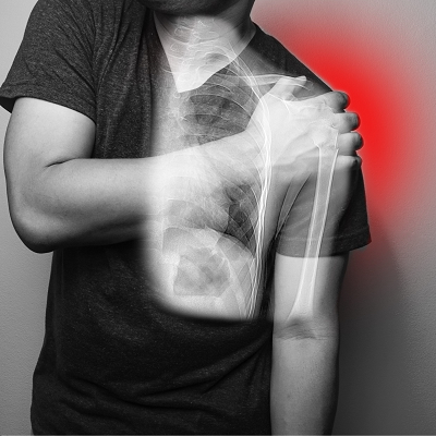 How to Treat a Dislocated Shoulder