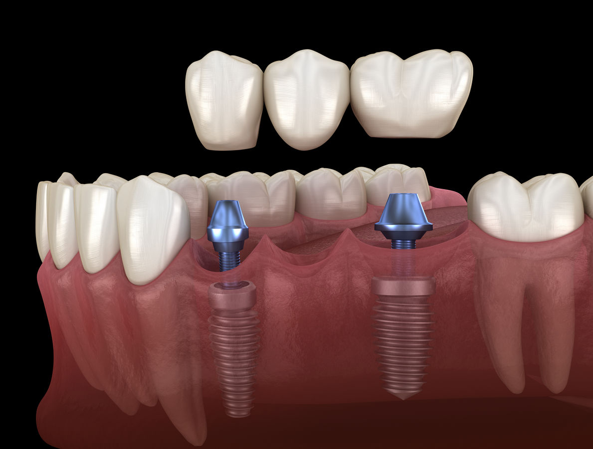 Which is better, a bridge or an implant?