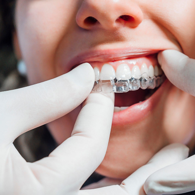 Best Clinic For Teeth Aligners in Islamabad