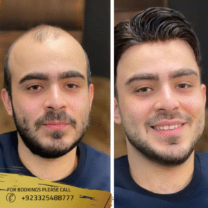 Best Results of Hair Transplant in Pakistan