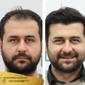 Cost of hair transplant