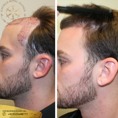 Does Dr. Naveed Provide Guaranteed Results for Hair Transplant