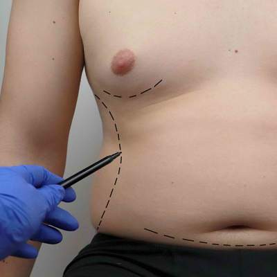Does Royal Cosmetic Surgery Clinic Provide The Best Results for Gynecomastia