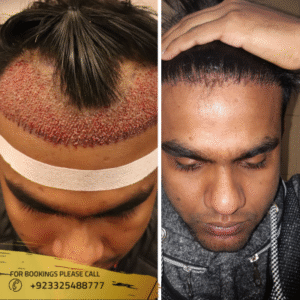 FUE FOLLICULAR UNIT EXTRACTION HAIR TRANSPLANT BEFORE AFTER IMAGES