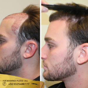 FUE Hair Transplant Before After Results in Islamabad
