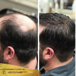 Hair Transplant in Islamabad Pakistan