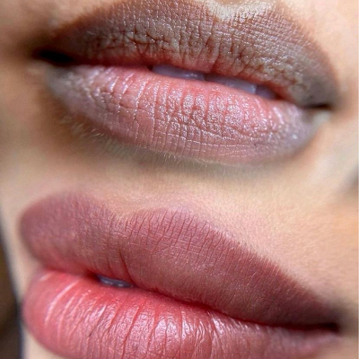 How Many Laser Sessions Are For Lip Pigmentation Treatment?