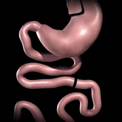 How Much Does Gastric Bypass Surgery Cost in Islamabad