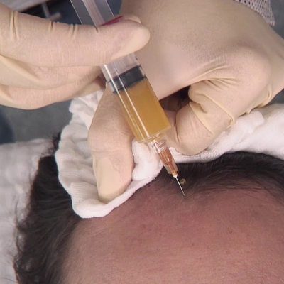 How Much is One Injection of PRP in Islamabad?