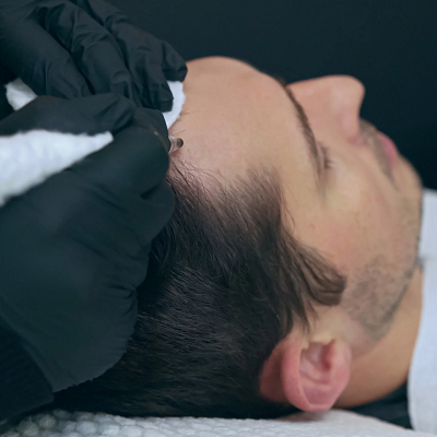 How Scalp Micropigmentation is Performed