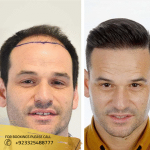 Natural Hair line hair transplant results in islamabad