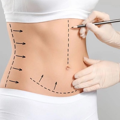 Would Liposuction Improve My Physique?