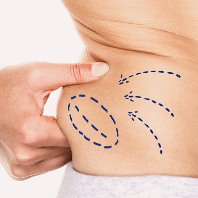 Best Liposuction Clinic in Islamabad