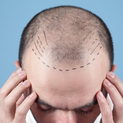 Can Transplanted Hair Still Turn Gray?