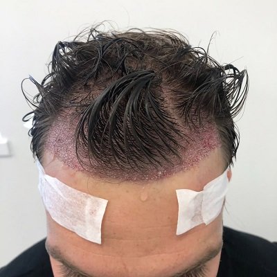 How Soon Can You See Hair Growth After a Hair Transplant?