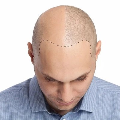 How to Sleep After Scalp Micropigmentation in Islamabad?