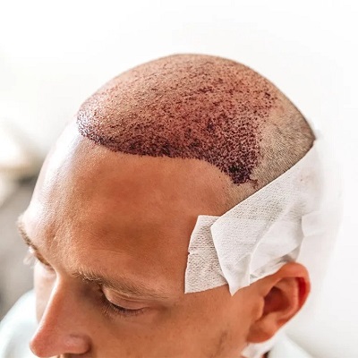 Scalp Micropigmentation Treatment Near Me
