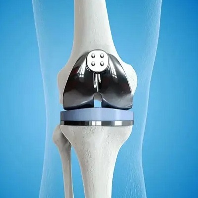 Total Knee Replacement Surgery Cost in Islamabad