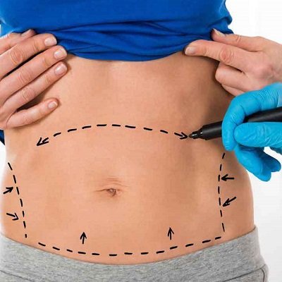 Tummy Tuck With Liposuction Cost in Islamabad