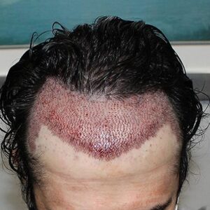 When is Too Late For a Hair Transplant?