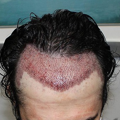 When is Too Late For a Hair Transplant?