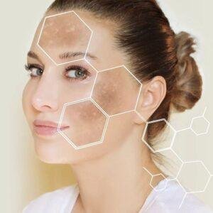 Can High Blood Sugar Cause Melasma?