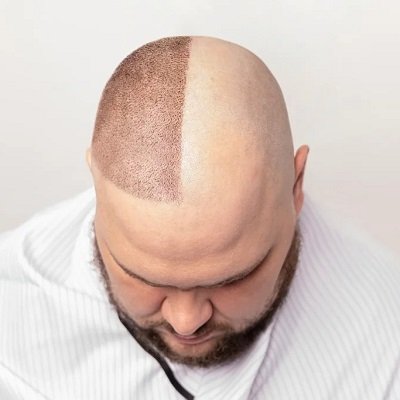 Can I Consult Hair Transplant Doctors Online in Islamabad?