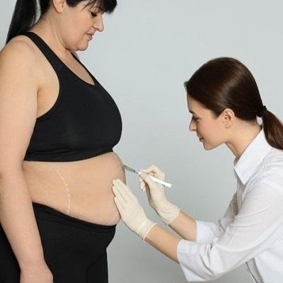 Does your stomach grow back after bariatric surgery?