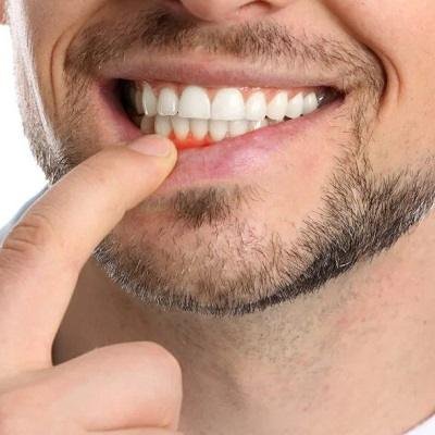 How Many Days of Pain After a Root Canal?