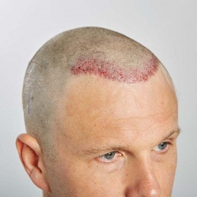 Is SMP Better Than a Hair Transplant in Islamabad?