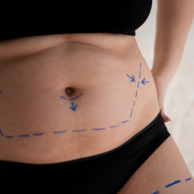 Liposuction Cost in Islamabad