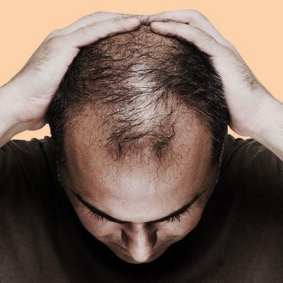 Which Vitamin Deficiency causes hair loss?
