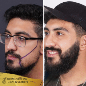 beard-hair-transplant-before-and-after-male