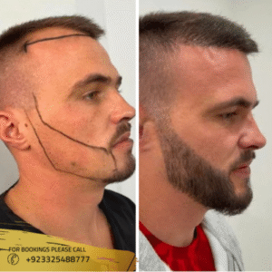 beard-hair-transplant-before-and-after-photos