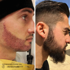 beard-hair-transplant-before-and-after-pictures