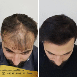 exosomes-hair-loss-before-and-after