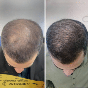 exosomes-hair-results