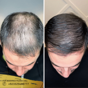 exosomes-in-islamabad