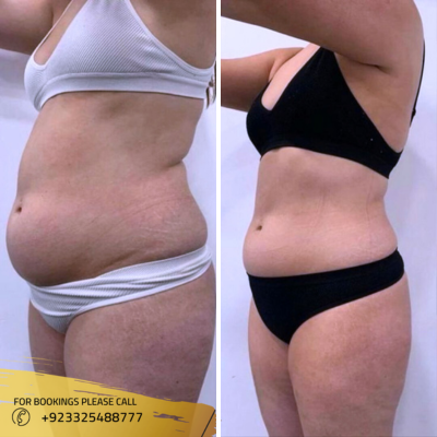 Mounjaro in Islamabad Pakistan Weight loss Injection