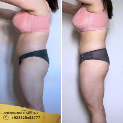 Mounjaro in Islamabad Pakistan Weight loss Injection