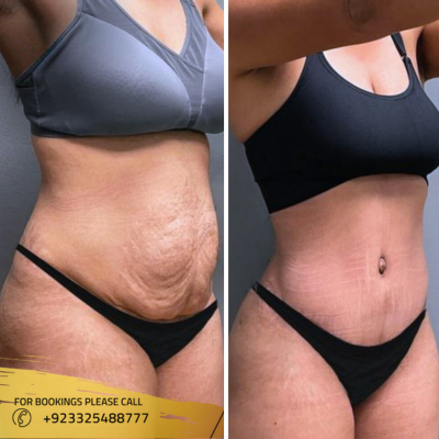 Mounjaro in Islamabad Pakistan Weight loss Injection