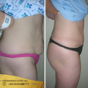 tummy-tuck-before-and-after (1)