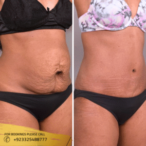 tummy-tuck-in-islamabad-pakistan