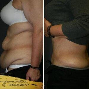 tummy-tuck-surgery-before-and-after